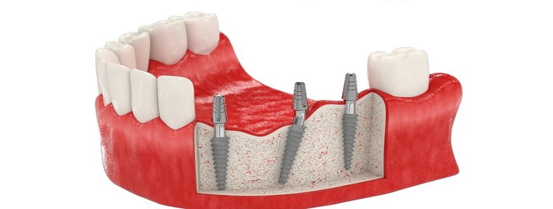 Какой имплантат лучше для жевательного зуба?