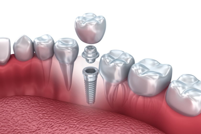 Что нужно знать перед имплантацией зубов - ликбез для пациента