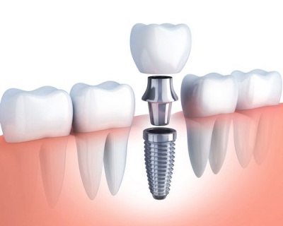 Какой имплантат лучше для жевательного зуба?